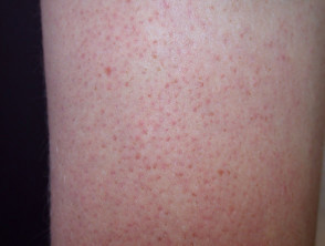 Child with Keratosis Pilaris