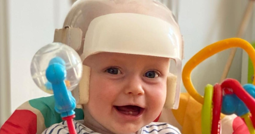 Photograph of a baby wearing a special helmet to help correct their skull deformity